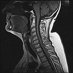 MRI на съдовете на шията и мозъка, шийните прешлени