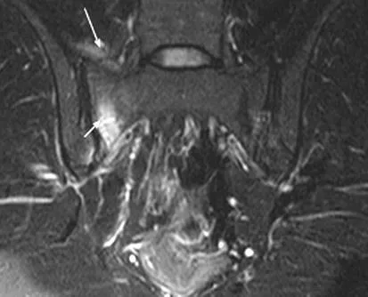 Експерт MRI MRI в изследването на сакроилиачните стави