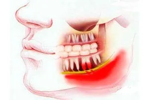 gume supurație după tratament extracție dentară