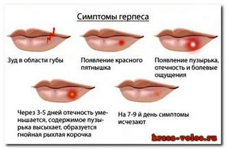 Народен лек за херпес - отговори и съвети