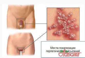 A népi orvosság herpesz - válaszokat és tanácsokat