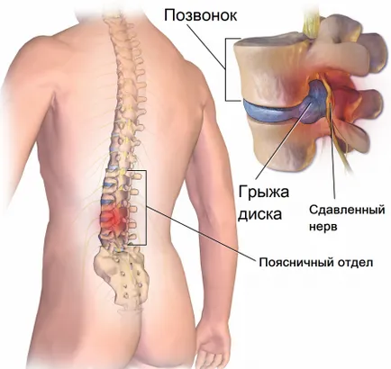 încălcarea potență în osteocondrozei și hernie intervertebral București