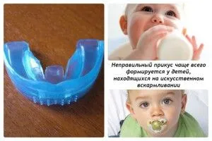 Malocluzie copilului la ce vârstă a pus aparat dentar