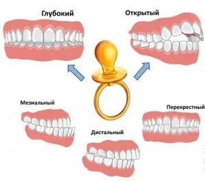 Захапка на детето на каква възраст поставят скоби