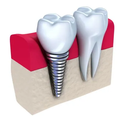 Незабавно поставяне на импланта при премахването на зъбите плюсовете и минусите на услуги - статии за стоматология