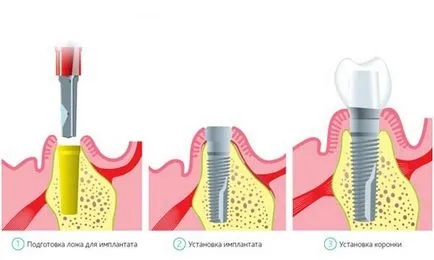 Egyidejű implantáció - alkalmazott anyagok