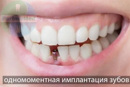 Едновременно зъб цена имплантиране