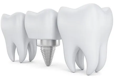Едновременно зъб цена имплантиране