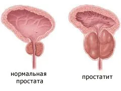 Тумор на простата простатит, киста, аденом на простатата (хиперплазия), рак на