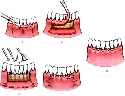 Operațiuni chiuretaj buzunare gingivale - modul de a efectua curățarea pungilor parodontale