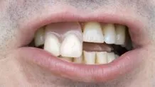 Основни зъбни импланти алтернативни характеристики, предимства и недостатъци