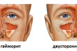 Akut sinusitis tünetei és kezelése (videó)