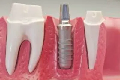 Fő fogászati ​​implantátumok alternatív jellemzői, előnyei és hátrányai