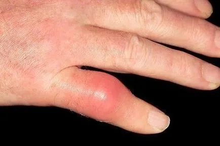 A fő tünetek a thrombophlebitis kezek