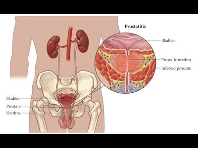 Panacea este! Cum să fie tratate pentru a recupera și de a trăi un cancer de vindecare fără semne de boală, diabet, prostatita