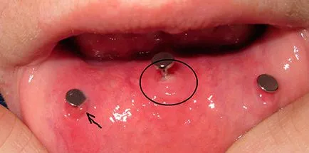 Piercing a felső és az alsó ajka, típusok következményeit, szúrások felett és alatt az ajak gyűrű és más ékszerek