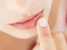 Miért ajkak száraz és repedés - az ok és a kezelés