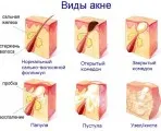 Акне Sun за след слънце