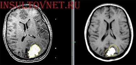 Признаци на инсулт при мъжете след внезапна поява на алкохол