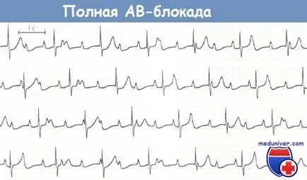 Semnele de bloc AV de gradul III pe o electrocardiograma - o blocada totala