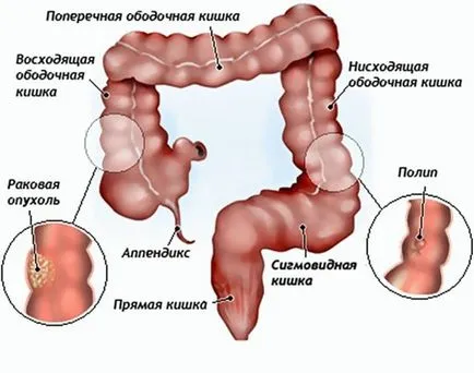 Ракът от хемороиди