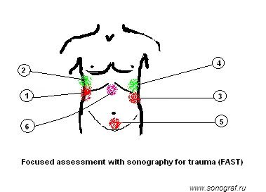 Регионални анестезия по ултразвук - аварийно ултразвук в травма (бързо)