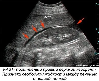 Regionális anesztézia alatt ultrahang - sürgősségi ultrahang trauma (gyors)