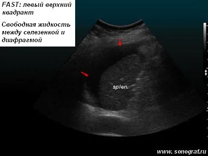 Regionális anesztézia alatt ultrahang - sürgősségi ultrahang trauma (gyors)