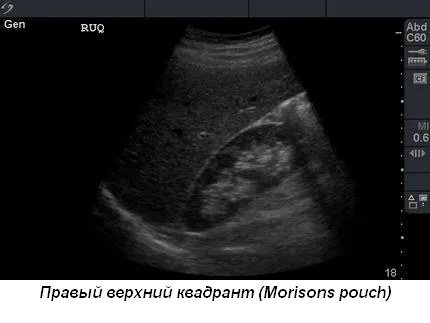 Regionális anesztézia alatt ultrahang - sürgősségi ultrahang trauma (gyors)