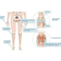 Cauzele artrita reumatoida, simptome, prevenirea