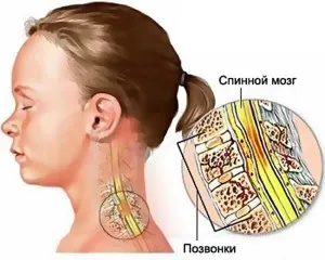 Симптоми и лечение на изкълчване на шиен прешлен