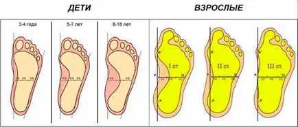 Симптоми и причини за плоски стъпала и как да се отнасяме