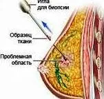 biopsie de san Stereotactica