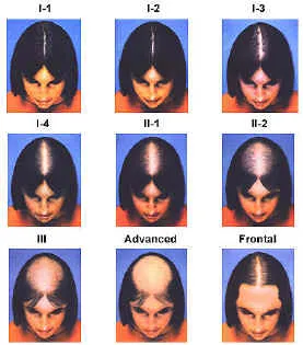 A mértéke alopecia, kopaszság