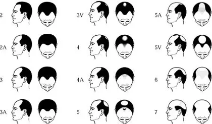 A mértéke alopecia, kopaszság