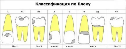 Szakaszában fogszuvasodás, fogszuvasodás fokozat (fotó és videó)