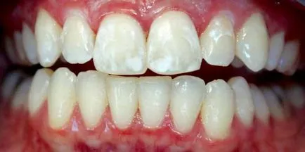 Szakaszában fogszuvasodás, fogszuvasodás fokozat (fotó és videó)