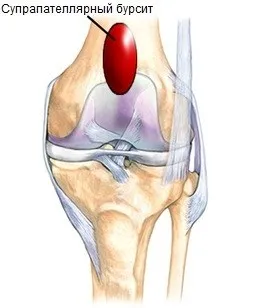 Suprapatellyarny bursitis a térdízület - tünetek és kezelés