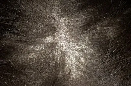 Simptomele Dry seboreea scalpului si tratamentul bolii