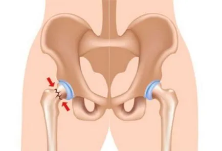 șold Anatomia omului comun (structura) și funcția, patologie