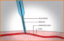 Thermocoagulation - Centrul Medical de cosmetologie Oksana Volkova