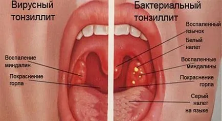 Amigdalita este contagioasă dacă acesta este trecut în jurul valorii de