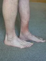 Sebek a lábak - típusok, tünetek, kezelés