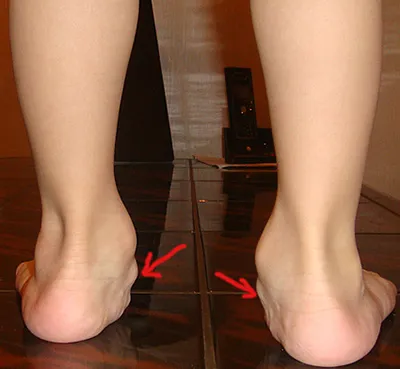 Sérülések a láb ízületek, gyulladás tünetei és gyulladások kezelésére, rándulások és fájdalmak