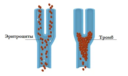 Tromboza, simptome pulmonare si tratament