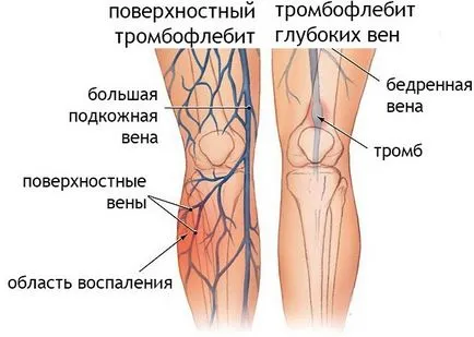 Тромбоза на долните крайници симптомите, ранни признаци, лечение на лекарствата