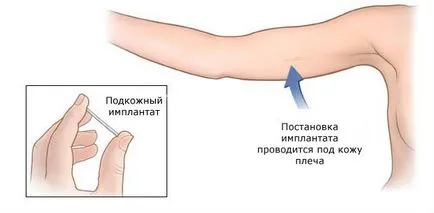 plasarea implantului Implanon - Tyumen neo-slinic