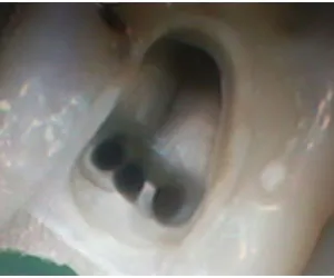 Tratamentul endodontic cu microscop dentar evolutia XR6