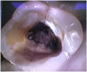 Tratamentul endodontic cu microscop dentar evolutia XR6