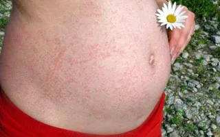 Eczema în timpul sarcinii - ce să facă și cum să trateze